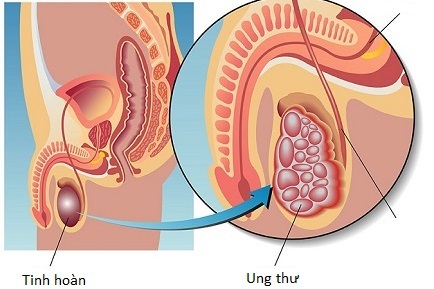 Ảnh 1 của Cancer of the testicles